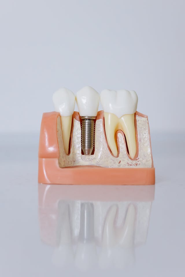 Dental Implants - Permanent tooth solution with titanium implants at Dr. Dentium Dental Clinic