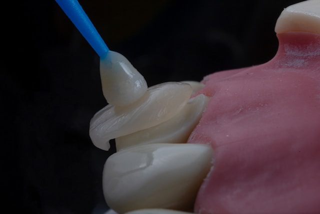 Dental Veneers - Smile makeover with thin shells at Dr. Dentium Dental Clinic