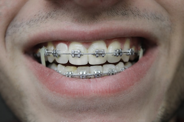 Metal Braces - Correct crooked teeth with traditional braces at Dr. Dentium Dental Clinic